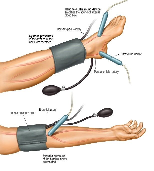 Positioning of the blood pressure monitor cuff on the ankle/ lower