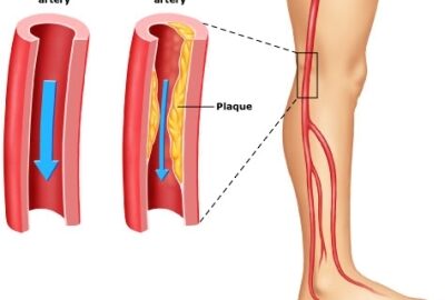 Peripheral Artery Disease Blockage